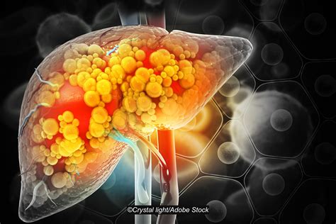 Semaglutide Takes The Stage As A Potential Tx For Mash