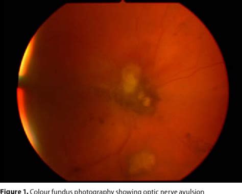 Figure 1 from Optic nerve avulsion after blunt ocular trauma - Case report. | Semantic Scholar