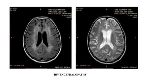 white matter disease mri Mri lesions diffuse axial - Diseases Club center