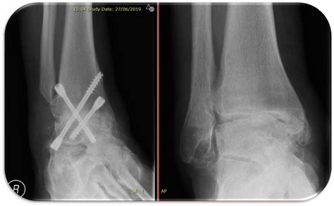 Ankle Fusion Dubai Ankle Fusion Surgery In Dubai Dr Ehab Kheir