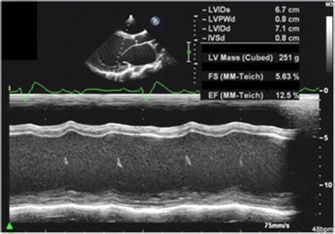 M Mode Echocardiographic Recordings From The Index Patient Showing