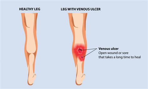 Venous Leg Ulcer: Symptoms, Causes, and Prevention