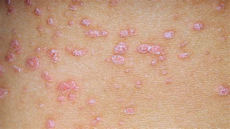 Fast Five Quiz Psoriasis Types