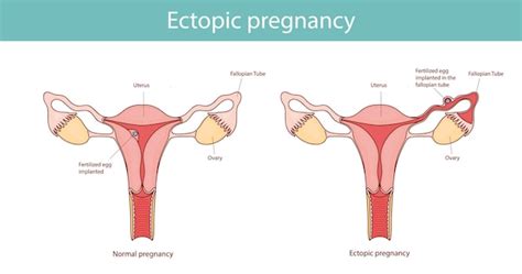 Embarazo Ectópico Problema De Embarazo En Comparación Con El Embarazo