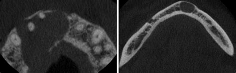 Of Ultrasonography In Maxillofacial Intraoral Inflammatory And Cystic