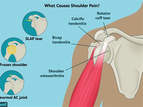 Back Shoulder Pain Diagnosis Chart - Best Picture Of Chart Anyimage.Org