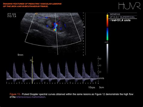 Figure 7 From Imaging Features Of Pediatric Vascular Malformations Of The Skin And Subcutaneous