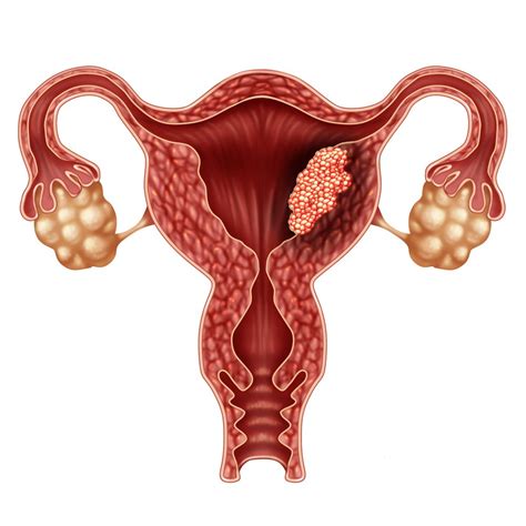 Endometrial Cancer Overview Causes Symptoms Treatment Illness