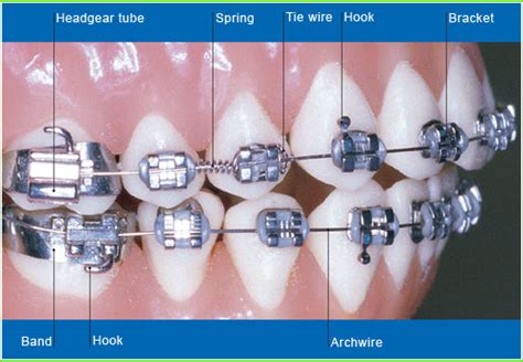 Parts Of Braces Bordentown Braces