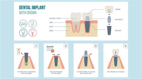 Dental Implants Process Timeline Guide Omega Dental Houston