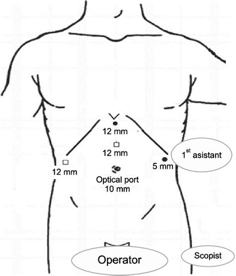 The Trocar Location Of Laparoscopic Hepatectomy Download Scientific