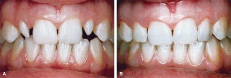 Direct Restorative Treatment Of Peg Shaped Maxillary Lateral Incisors