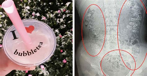 Doctors Discover Hundreds Of Bubble Tea Balls In Girl S Stomach 22w