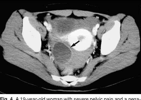 Hemorrhagic Corpus Luteum Ultrasound