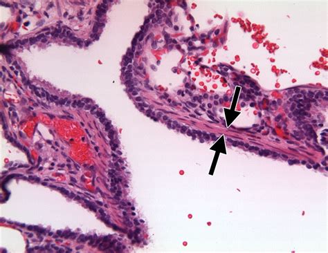 Airp Best Cases In Radiologic Pathologic Correlation Type 2 Congenital Cystic Adenomatoid