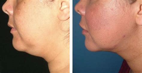 Double Chin Fat Dissolving Injections The Laserina Clinic