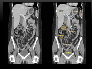 Ct abdomen | PPT | Free Download