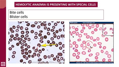 Hematology 2 U1 L9 Specific Cells Are Seen In Special Types Of Ha