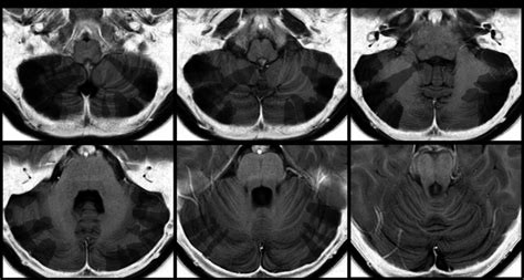 Cerebellar Lesions Of Our Tuberous Sclerosis Complex Tsc Sample 112