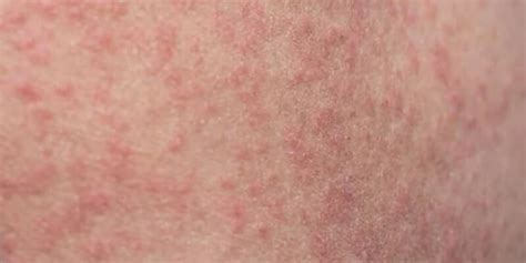 Roseola Causas S Ntomas Y Tratamiento Blog Saludonnet