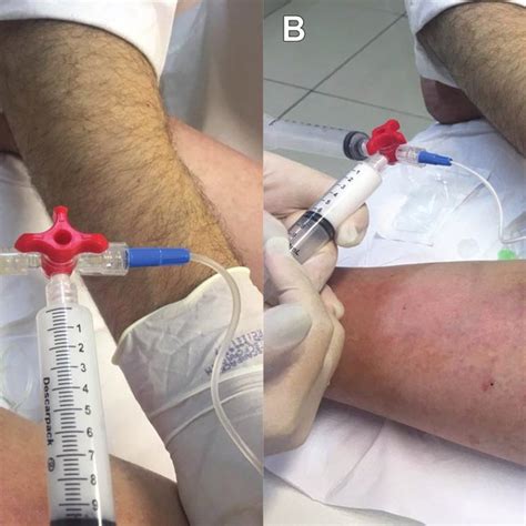 Images From Case 3 Posttraumatic Lymphocele Drainage Of Approximately