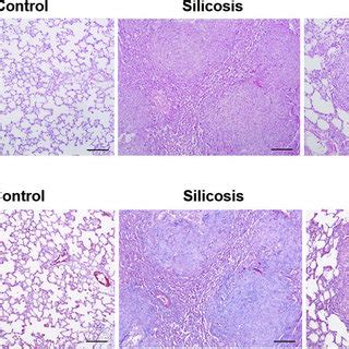 Tan Iia Treatment Attenuates Silica Induced Pulmonary Fibrosis In