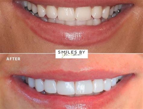 Dental Implants A Complete Overview Smilesbygurms Co Uk