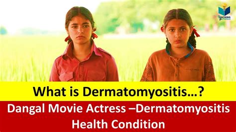 What is Dermatomyositis…? Symptoms, Treatment, Diagnosis, Cure ...