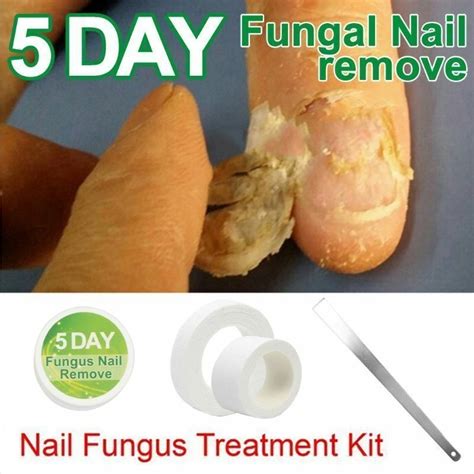 Nail Fungus Treatment Anti Fungal Nail Infection Essence Nail Treatment