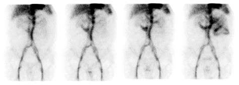 Gastrointestinal Bleeding