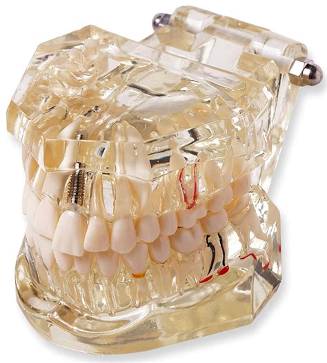 Dental Model For Patient Education With Pathologies To Demonstrate