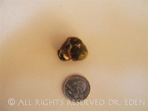 Gallstone Pictures Gallery See Images Of Real Gallstones Passed