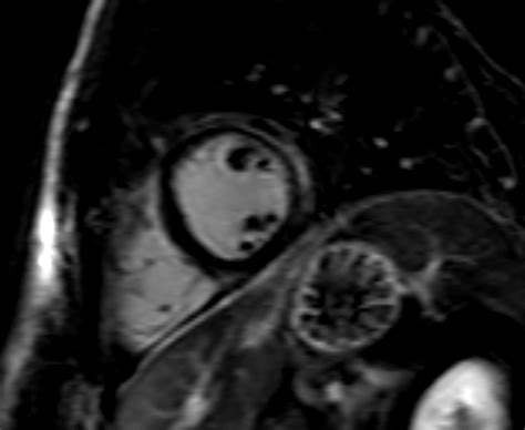 Acute Myocarditis Multiparametric Cardiac Mr Imaging Radiology