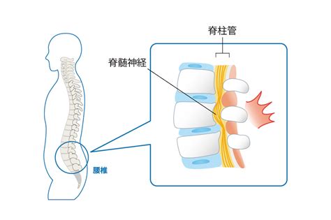 即効性のある腰痛の治し方とは？再発予防にオススメのストレッチや体操も紹介 株式会社リハサク