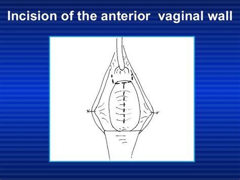 Modified Extended Anterior Vaginal Wall Repair For Cystocele