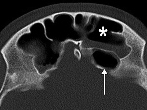 Failed Endoscopic Sinus Surgery Spectrum Of Ct Findings In The Frontal