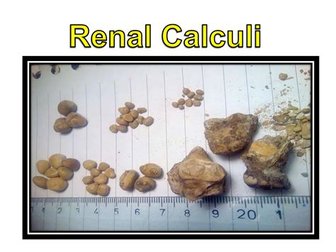 Renal Calculi Nephrolithiasis Kidney Stone Ppt