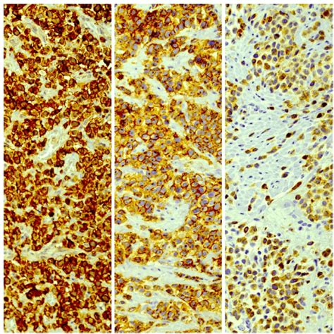 Immunohistochemical Staining Showed Positive Cd117 Left Lca Download Scientific Diagram