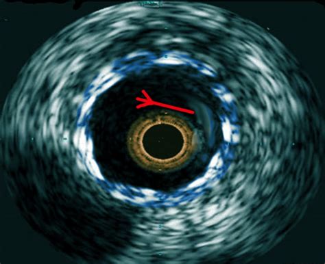 Figure Ivus In Stent Thrombosis Image Courtesy S Bhimji Md