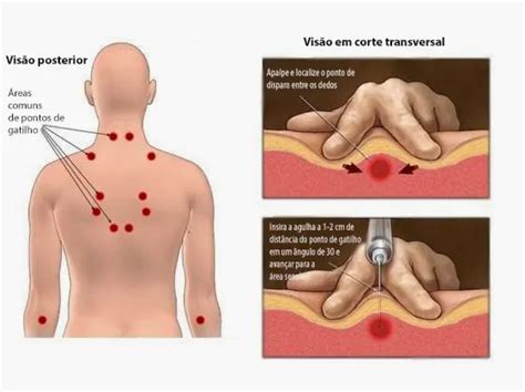 S Ndrome Dolorosa Miofascial Imov Instituto De Medicina Do