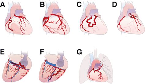 Coronary Artery Fistulas Pathophysiology Imaging Findings And