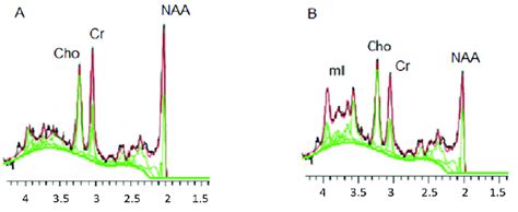 Examples Of Magnetic Resonance Spectroscopy Mrs Spectra In Totally