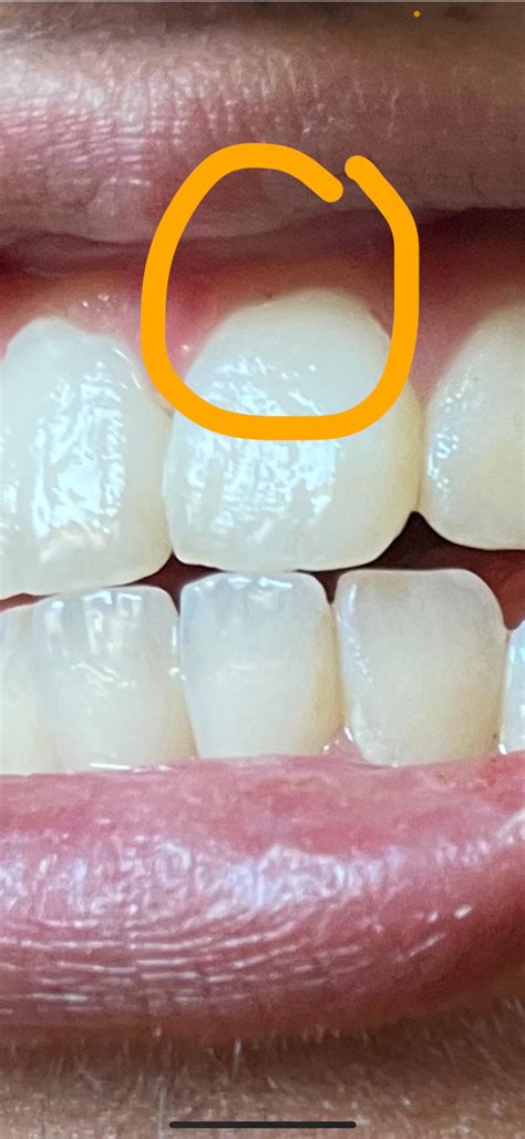 Anyone Know What That Little Black Dot Above My Front Tooth Is Im Worried About My Gums Also