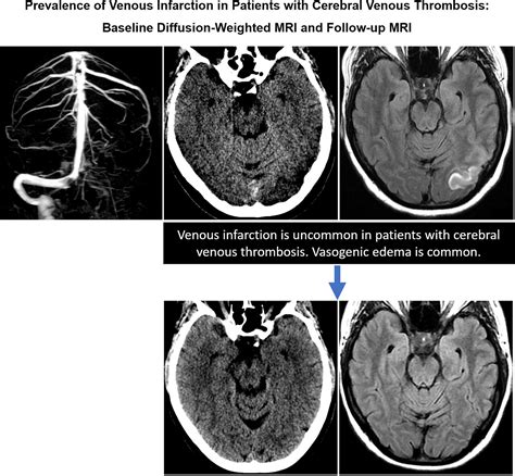 Prevalence Of Venous Infarction In Patients With Cerebral Venous