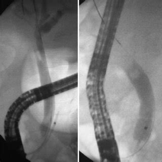 Pancreatic stent with radiological marker in the main pancreatic duct ...