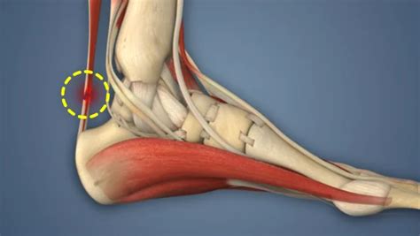 Achilles Tendon Rupture – UnderstandOrtho™