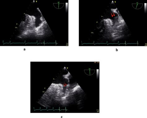 Comparison of the left atrial appendage preoperatively,... | Download ...