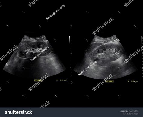 Kidney Stone Ultrasound