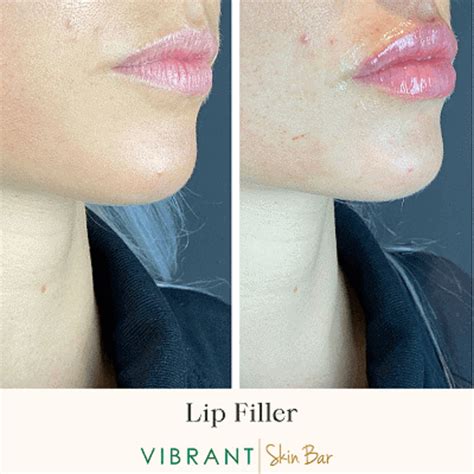 Hyaluronic Acid Lip Fillers Everything You Need To Know