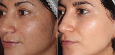 Bbl Laser Skin Rejuvenation Before And After Photo Gallery Toronto